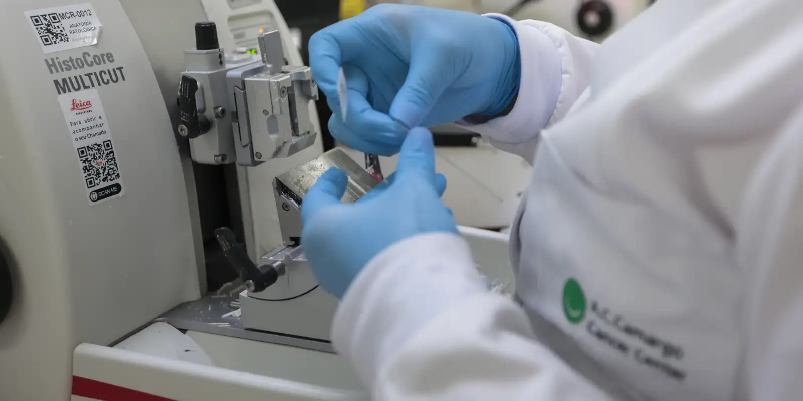 SUS incorpora venetoclax com azacitidina para leucemia mieloide aguda